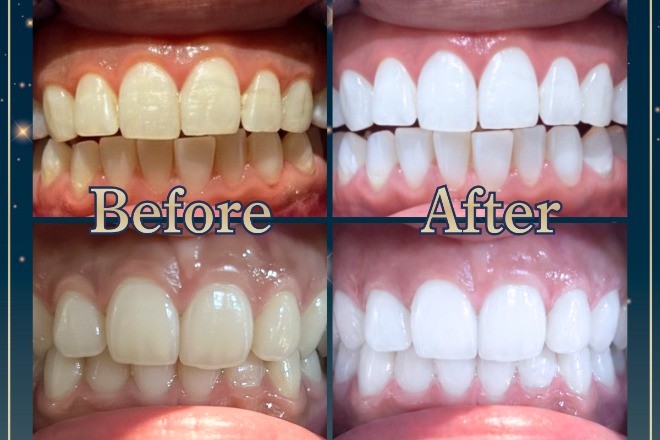 【Whi-Ya(ホワイヤ)】セルフホワイトニングDBS神楽坂